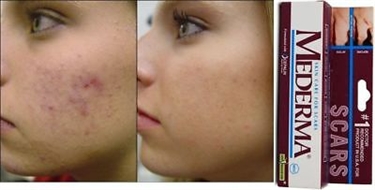 Remedies To Get Rid Of Scars