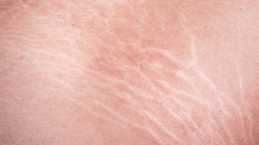 Stretch Mark Removal Dark Skin