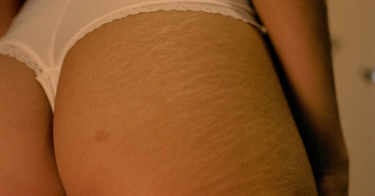 How To Make Stretch Marks Less Visible