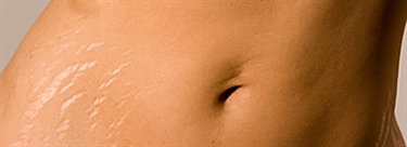 Severe Stretch Marks Pictures