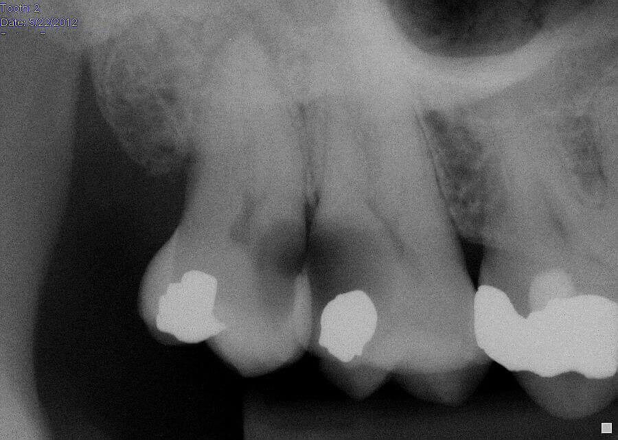 Extensive Caries on a Second Molar Adjacent to a Third Molar Case