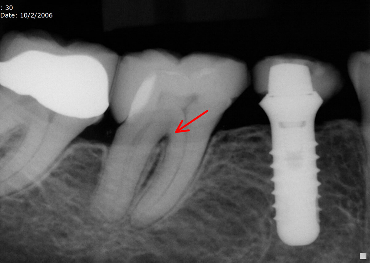 The Furcation Accessory Canal Case Studies Pure Dental Learning