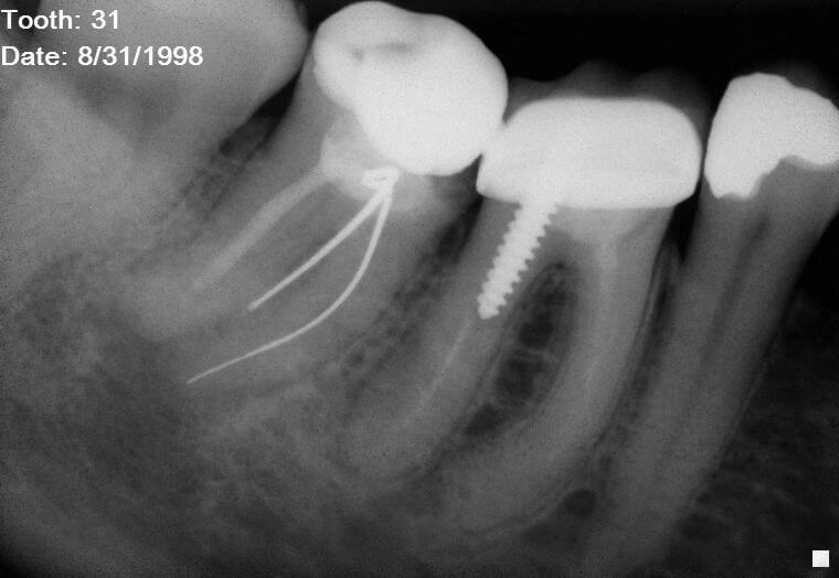 15 year recall Silver Point Retreatment Case Studies Pure Dental