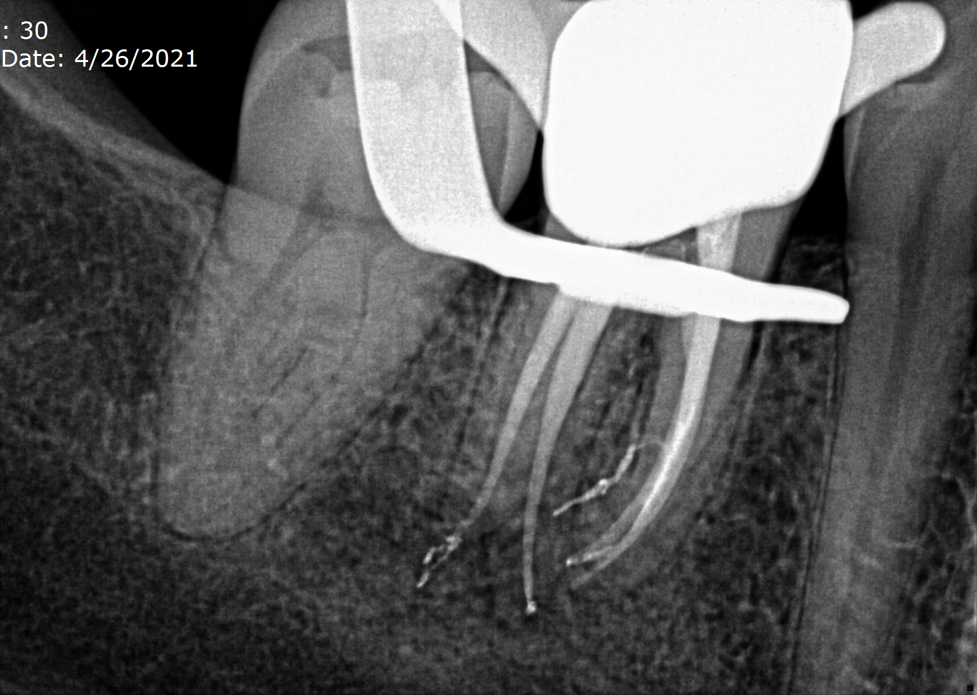 Endodontic Treatment Challenges of Complex Anatomy Case Studies