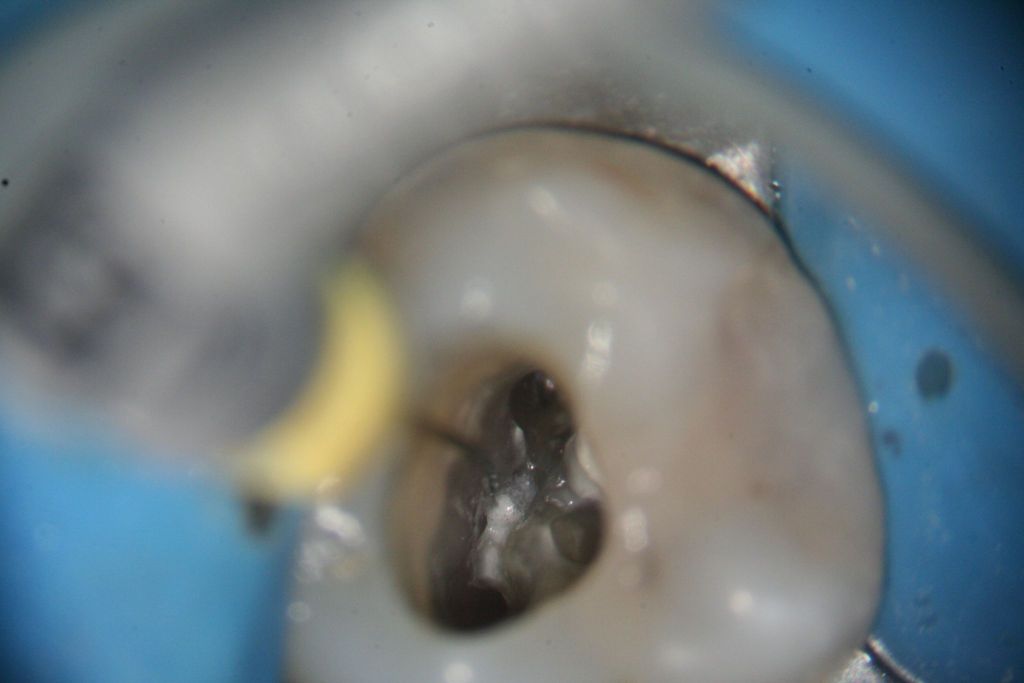 Maxillary Molar with Caries Adjacent to a Third Molar Case Studies