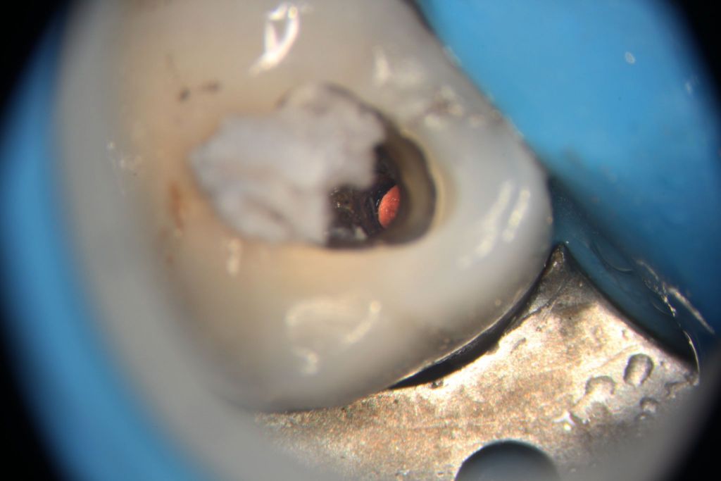 Retreatment of Maxillary Molar with Cotton Pellet Left in Pulp Chamber Case Studies Pure