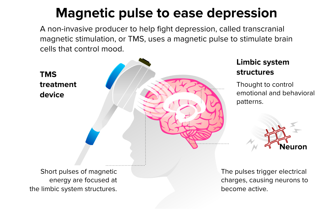 Transcranial Magnetic Stimulation: Could This Non-Medication Treatment Help You?