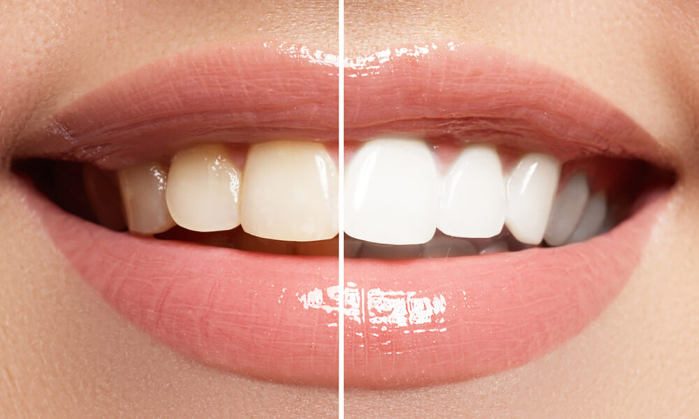 teeth-whitening-before-and-after