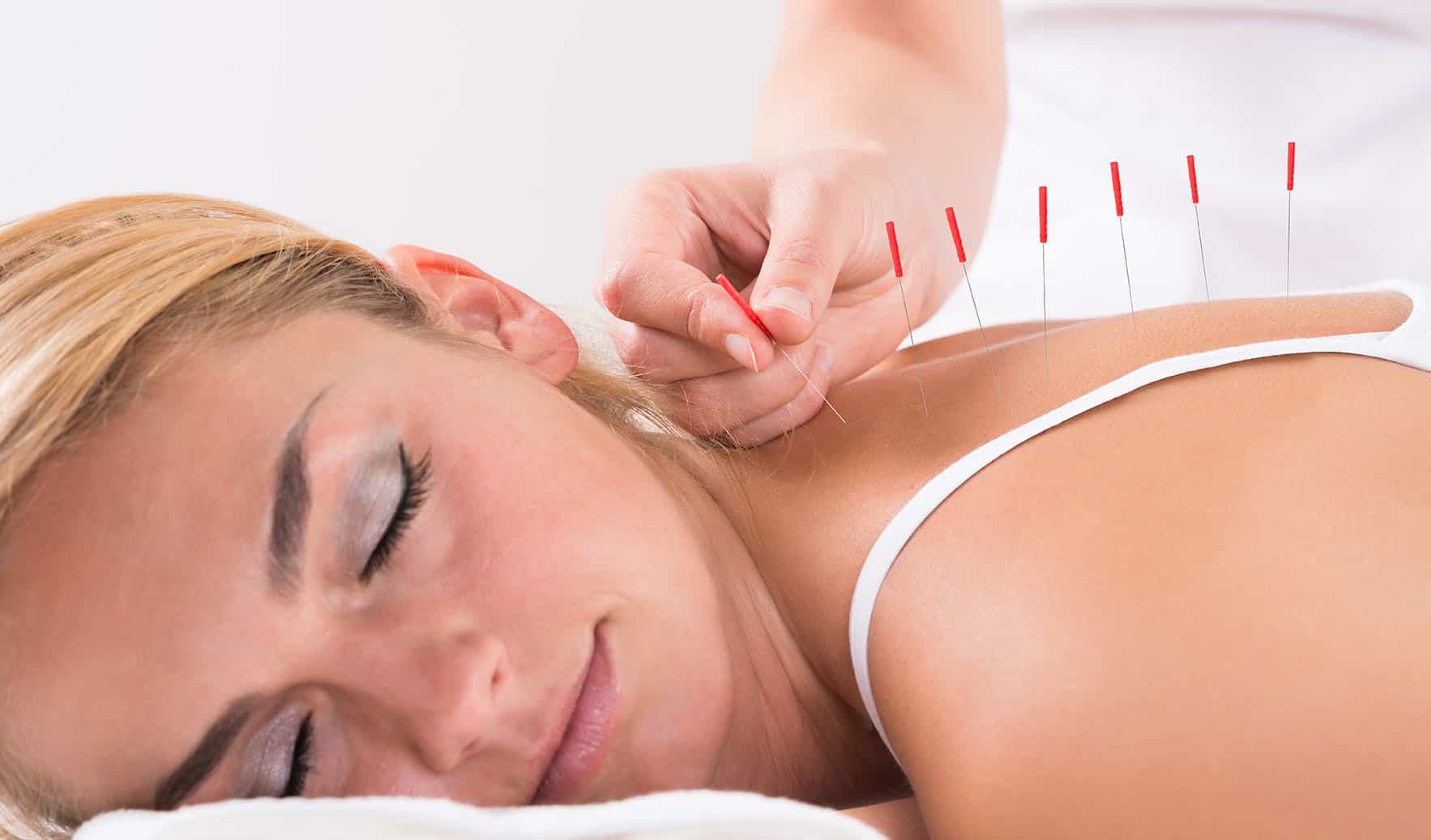 A woman Performing Acupuncture Therapy On Customer's Back