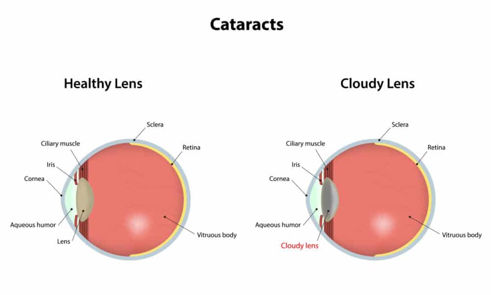 cataracts-symptoms-and-treatments