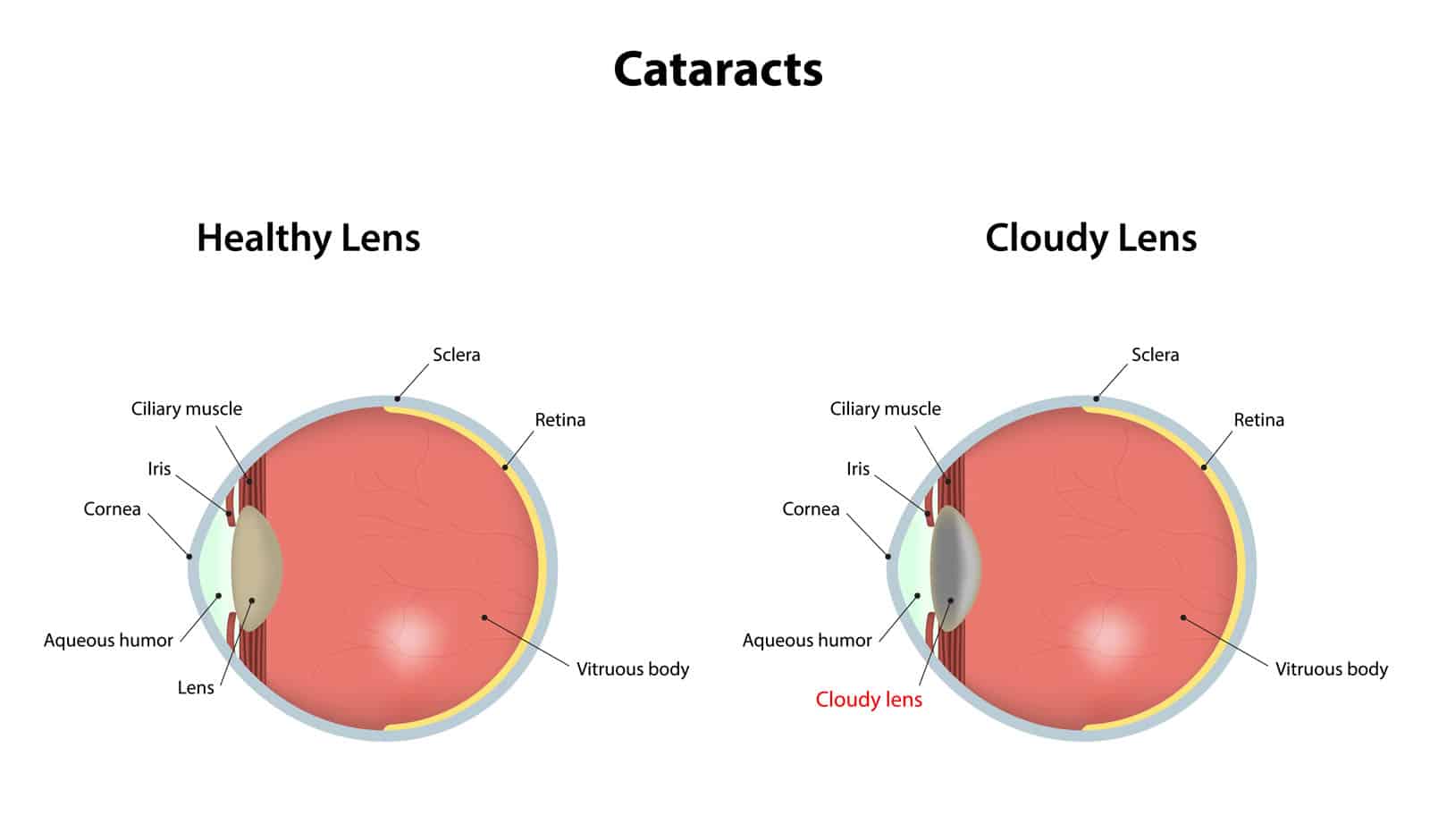 cataracts-symptoms-and-treatments